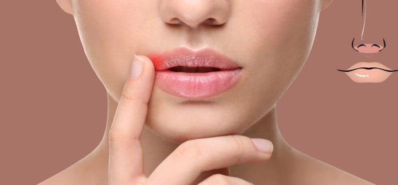 Differentiating-Between-Lip-Pimples-and-Cold-Sores