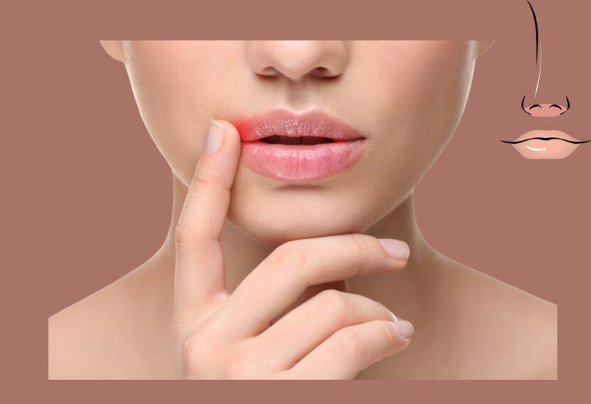 Differentiating Between Lip Pimples and Cold Sores