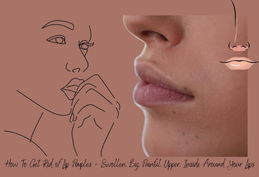 How To Get Rid of Lip Pimples