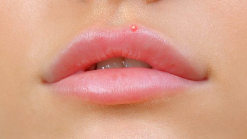 Upper Lip Pimples