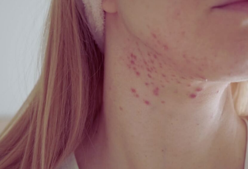 Chin Acne