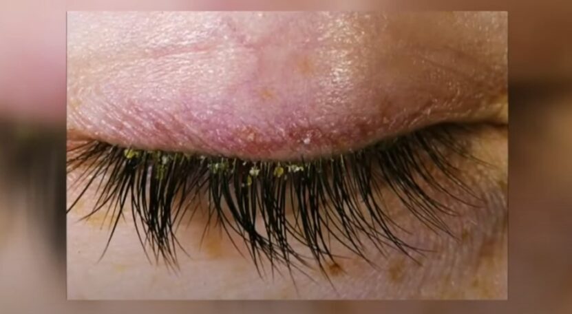 Diagnosing Eyelash Mite Infestation