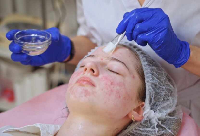 Professional Treatments Dermatological Procedures for Stubborn Chin Acne